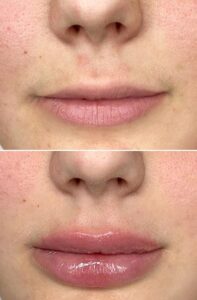 Treatments 3 Skinject pro lips before and after treatment
