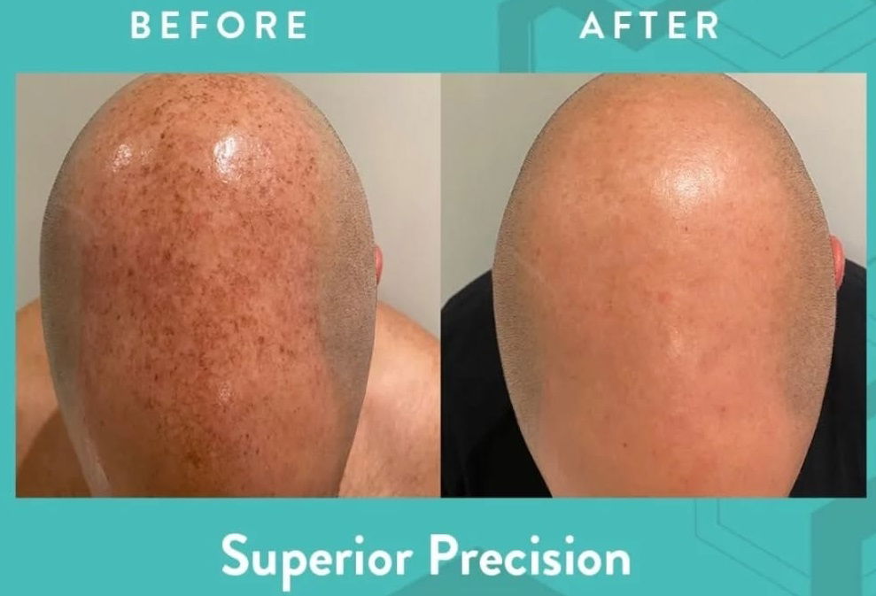 Lumecca Peak Acajou Treatment. Before and After images.