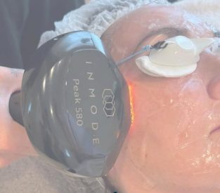 Lumecca Peak treatment. Remove brown spots.